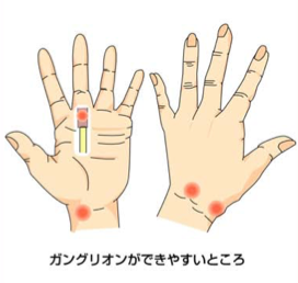 ガングリオンの原因と治療 日本手外科学会専門医のやまぐち整形外科 リウマチクリニック