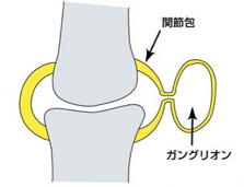 ガングリオンの原因と治療 日本手外科学会専門医のやまぐち整形外科 リウマチクリニック