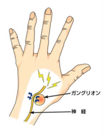 ガングリオンの原因と治療 日本手外科学会専門医のやまぐち整形外科 リウマチクリニック